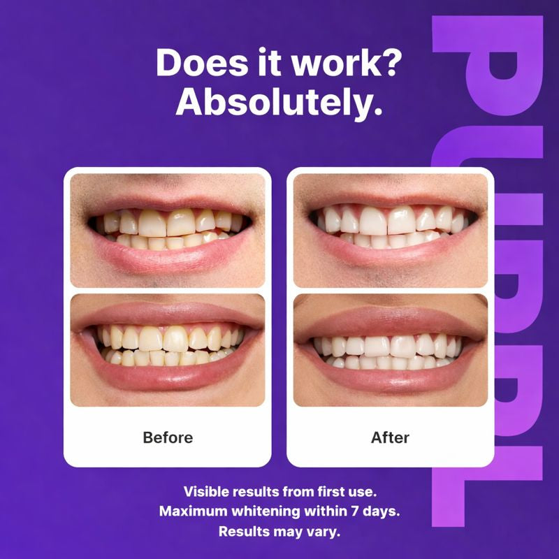 Color Correcting Whitening Strips